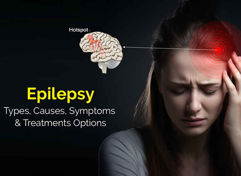 Epilepsy